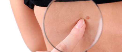 Ein Finger zeigt auf ein Geburtsmahl auf die mit einer Lupe rangezoomt wird